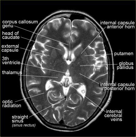 surface | Brain anatomy, Mri brain, Medical anatomy