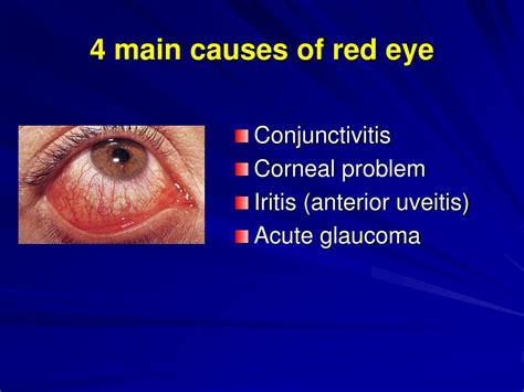 PPT - 4 main causes of red eye PowerPoint Presentation, free download ...