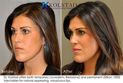 Lip Augmentation Before & After Gallery | Dr. Kolstad - San Diego ...