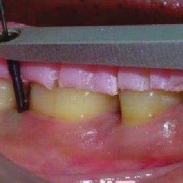 Preoperative view showing Florida probe in position | Download ...