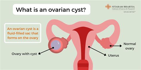 Ovarian Cyst - Is Surgical Treatment The Right Option?