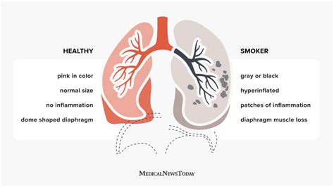 Smoker's lungs vs. healthy lungs: Facts, pictures, and more