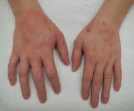 Dermatitis - Wikipedia