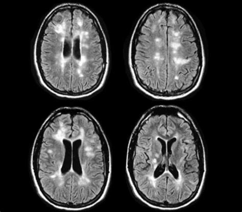 Ms Mri Brain Scan Results