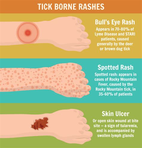 How to Prevent and Manage Tick Bites [Infographic]