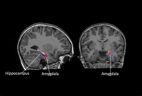 Enlarged amygdala may forecast anxiety, depression in autistic children ...