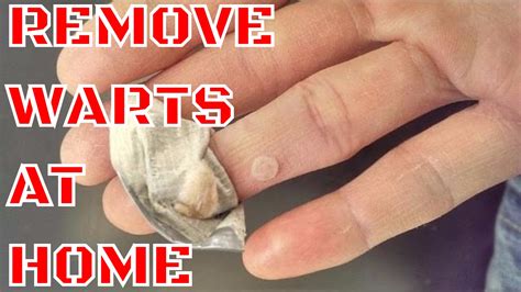 WART REMOVAL - HOW TO REMOVE WARTS AT HOME - YouTube