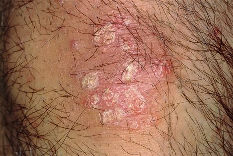 Stress and Psoriasis: What Is the Connection? - Dermatology Advisor