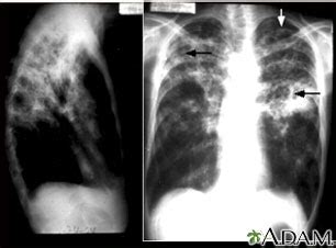 Abnormal Chest X Ray Tuberculosis