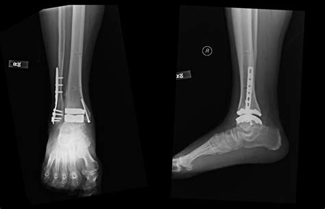 Leading-edge developments for total ankle arthroplasty - Keck Medicine ...