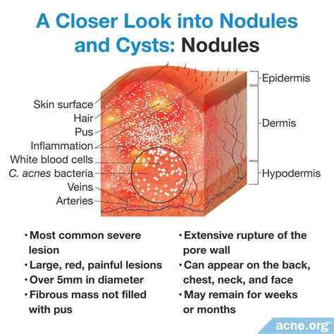 Mild Cystic Acne Diagram