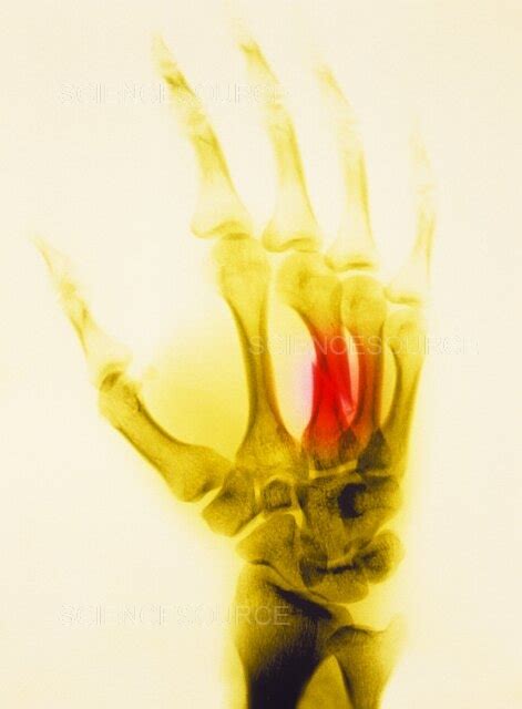 Photograph | Fractured hand x-ray | Science Source Images