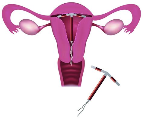 Copper IUD as Emergency Contraceptive Method - DTAP Clinic