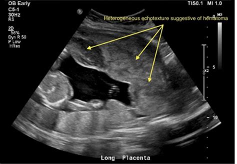 Placental Hemorrhage Ultrasound