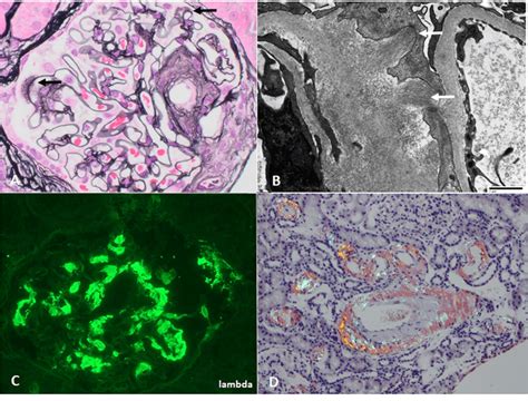 Kidney biopsy images of AL amyloidosis, with (A) "spicules" on Jones ...