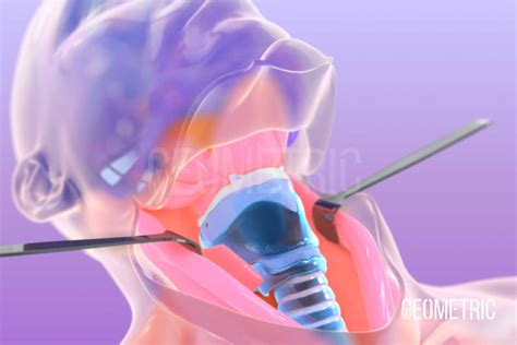 Laryngectomy Animation | Geometric Medical