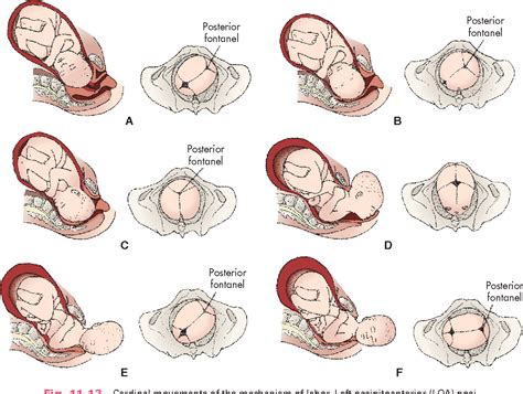 Figure 11-14 from Labor and Birth Processes Learning Objectives Key ...