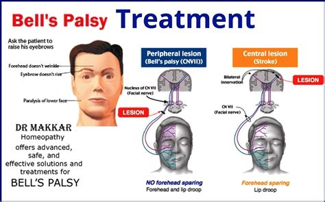 Facial Nerve Palsy Causes Symptoms Treatment Facial Nerve Palsy ...