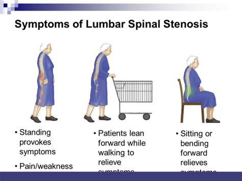 Lumbar Spinal Stenosis (LSS) - Delaware Valley Pain & Spine ...