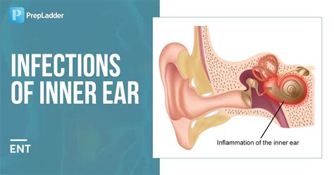 Infections of Inner Ear: Labyrinthitis, Vestibular Neuritis, Causes ...