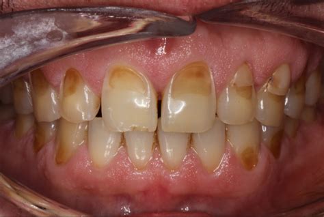 Teeth Erosion | News | Dentagama