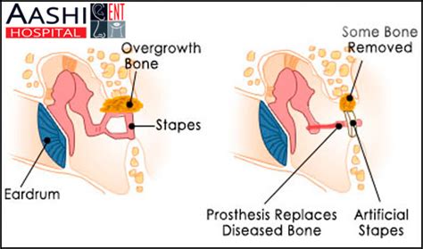 Stapedectomy, Stapedectomy Surgery in Ahmedabad