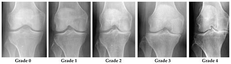 X-ray Stages Of Knee Arthritis