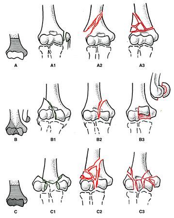 Distal Humerus Fracture Classification