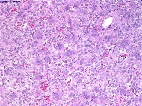 Giant Cell Tumor - Pathology - Orthobullets