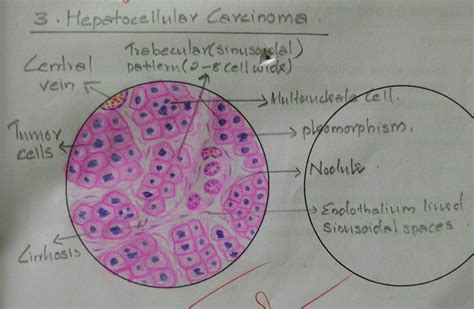 Histopathology Drawings: Hepatocellular carcinoma