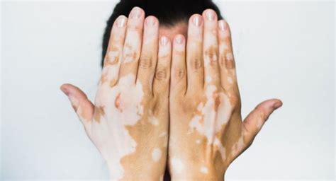 What are the Different Types of Vitiligo - Vitiligo Cured