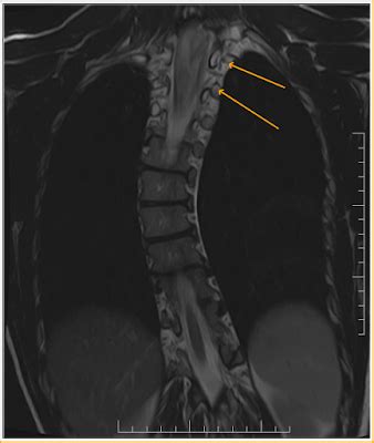 Spinal Ganglioglioma-MRI - Sumer's Radiology Blog