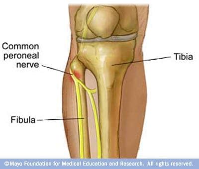 Nervio peroneo - Mayo Clinic