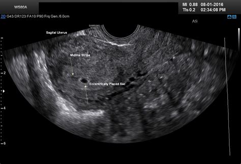 How Early Can A Molar Pregnancy Be Detected By Ultrasound - PregnancyWalls