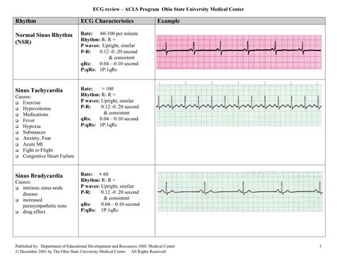 Rhythm Ecg Characteristics Example Normal Sinus Rhythm Nsr | Images and ...