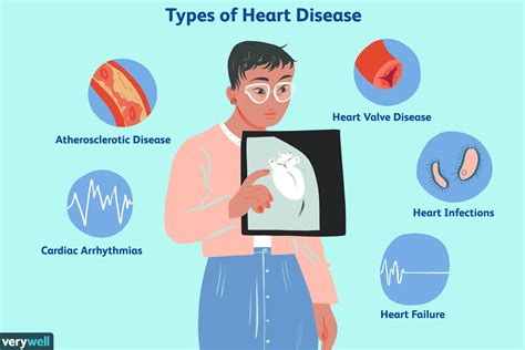 Heart Disease: Symptoms, Risk Factors Treatment, 42% OFF