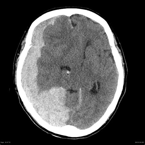 Subdural Hemorrhage CT Scan