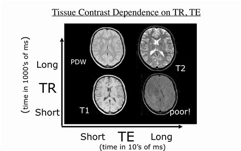 Mri T1 T2 Difference