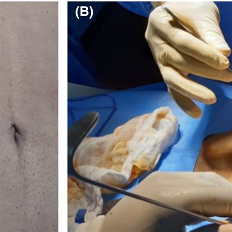 Surface marking of the distended gallbladder prior to palliative ...