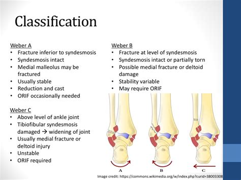 Weber Ankle Fractures — learnED