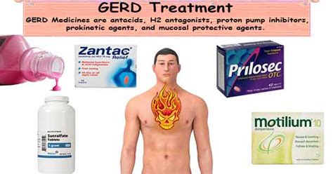 Acid Reflux Treatment | GERD Treatment | Acid Reflux Medication