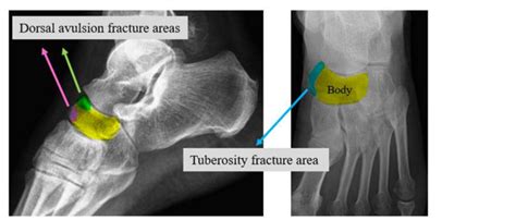 Navicular fractures areas Lisfranc Injuries Tarsometatarsal (TMT) joint ...