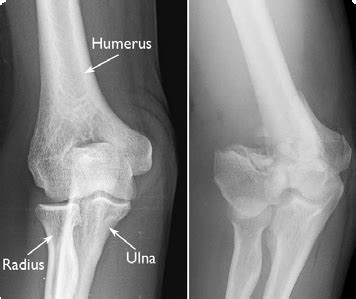 Distal Humerus Fracture Diagnosis | Boston Medical Center