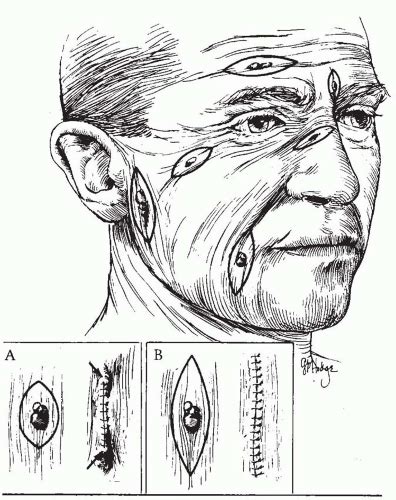 Techniques and Principles in Plastic Surgery | Plastic Surgery Key