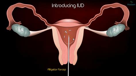 Intrauterine Device (IUD) Copper T Removal procedure - Patient ...