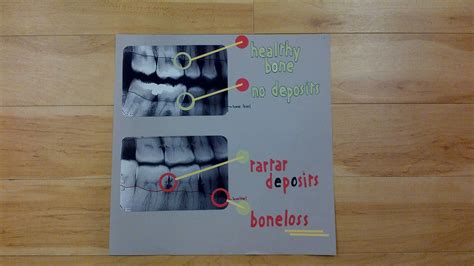 Dental xrays showing healthy bone levels vs. Unhealthy bone levels with ...