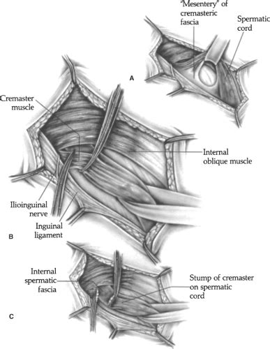 Iliopubic Tract Repair of Inguinal Hernia: the Anterior (Inguinal Canal ...