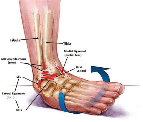 Osteochondral ankle defects(OCD): Symptoms & Treatments | Global ...