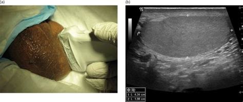 Testicular Edema Ultrasound