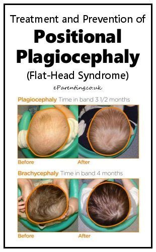 Positional Plagiocephaly (Flat-Head Syndrome)